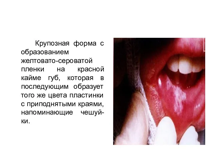 Крупозная форма с образованием желтовато-сероватой пленки на красной кайме губ, которая