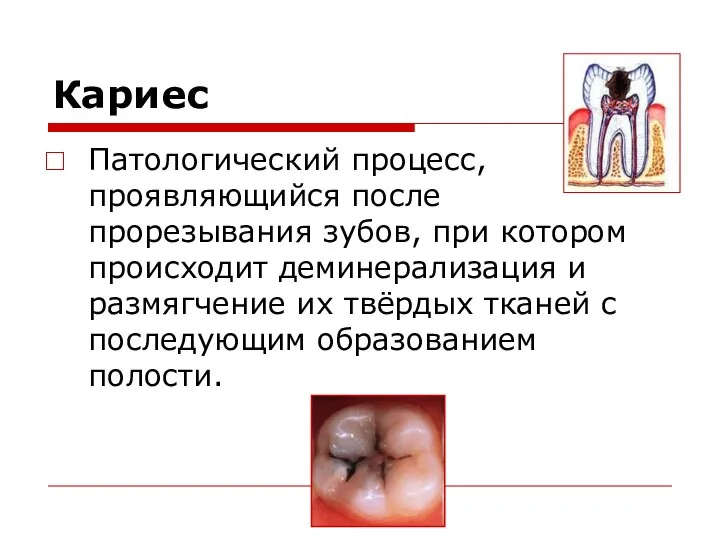 Кариес Патологический процесс, проявляющийся после прорезывания зубов, при котором происходит деминерализация
