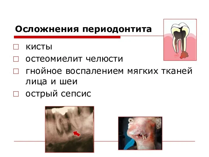Осложнения периодонтита кисты остеомиелит челюсти гнойное воспалением мягких тканей лица и шеи острый сепсис