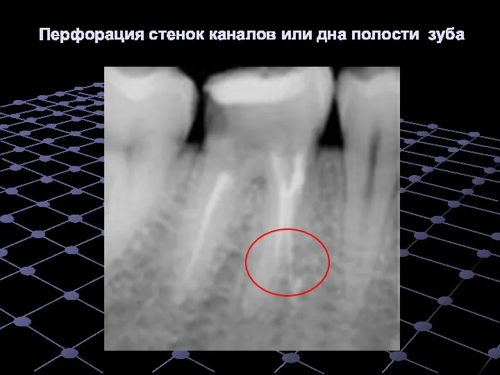 Перфорация стенок каналов или дна полости зуба