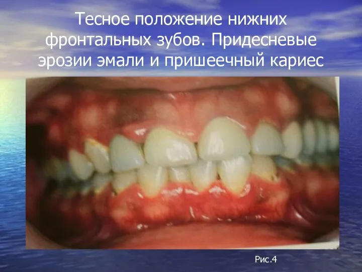 Тесное положение нижних фронтальных зубов. Придесневые эрозии эмали и пришеечный кариес Рис.4