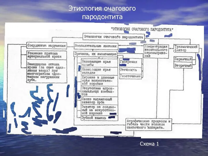 Этиология очагового пародонтита Схема 1