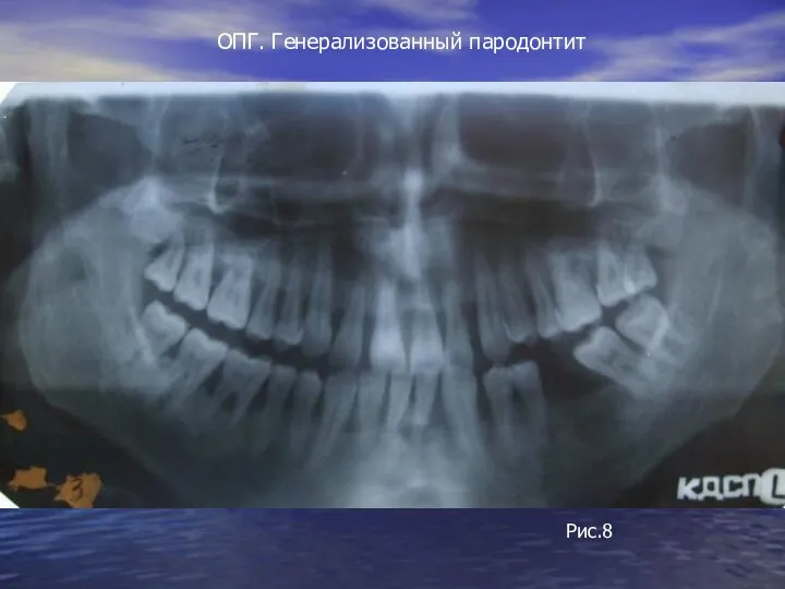 ОПГ. Генерализованный пародонтит Рис.8