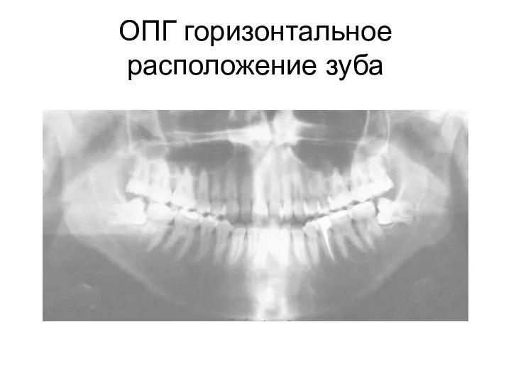 ОПГ горизонтальное расположение зуба