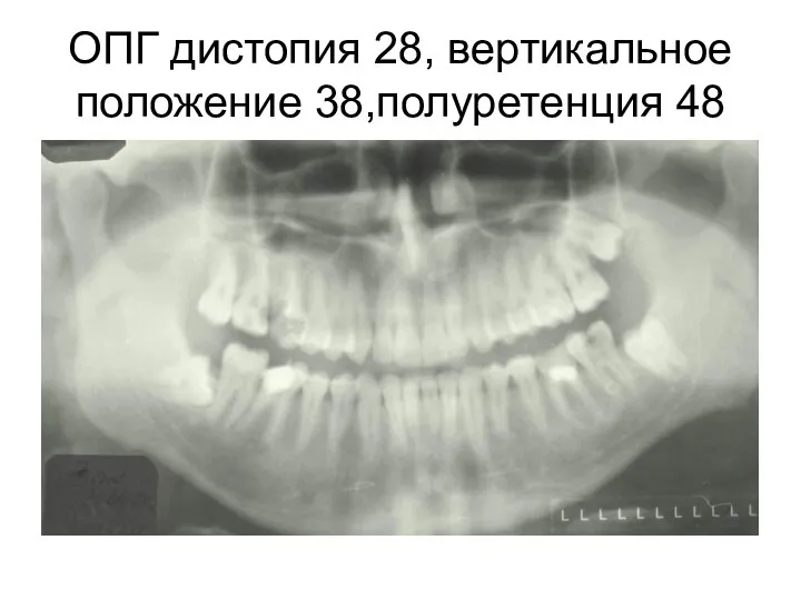 ОПГ дистопия 28, вертикальное положение 38,полуретенция 48