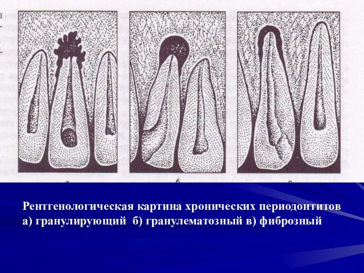 Рентгенологическая картина хронических периодонтитов а) гранулирующий б) гранулематозный в) фиброзный