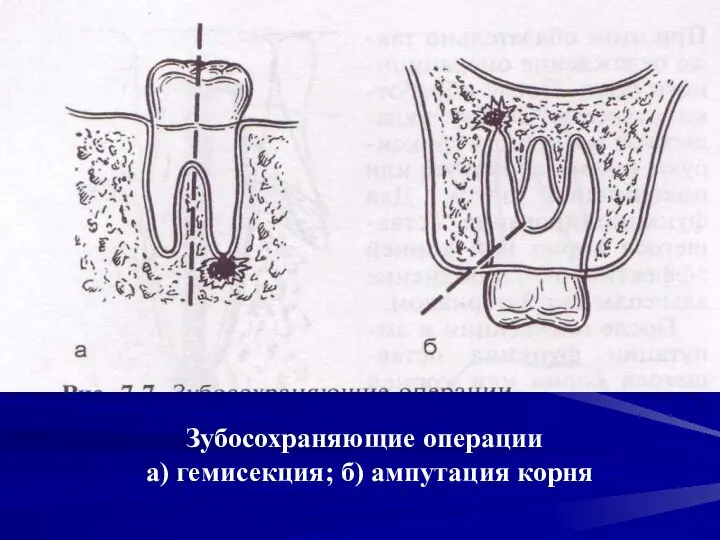 Зубосохраняющие операции а) гемисекция; б) ампутация корня