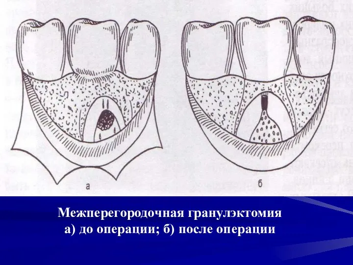 Межперегородочная гранулэктомия а) до операции; б) после операции