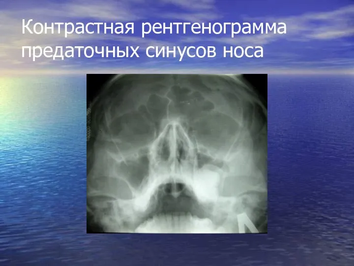 Контрастная рентгенограмма предаточных синусов носа