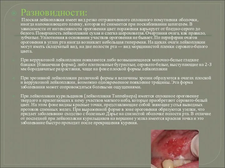 Разновидности: Плоская лейкоплакия имеет вид резко отграниченного сплошного помутнения оболочки, иногда