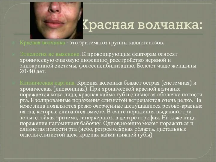 Красная волчанка: Красная волчанка - это эритематоз группы каллогенозов. Этиология не