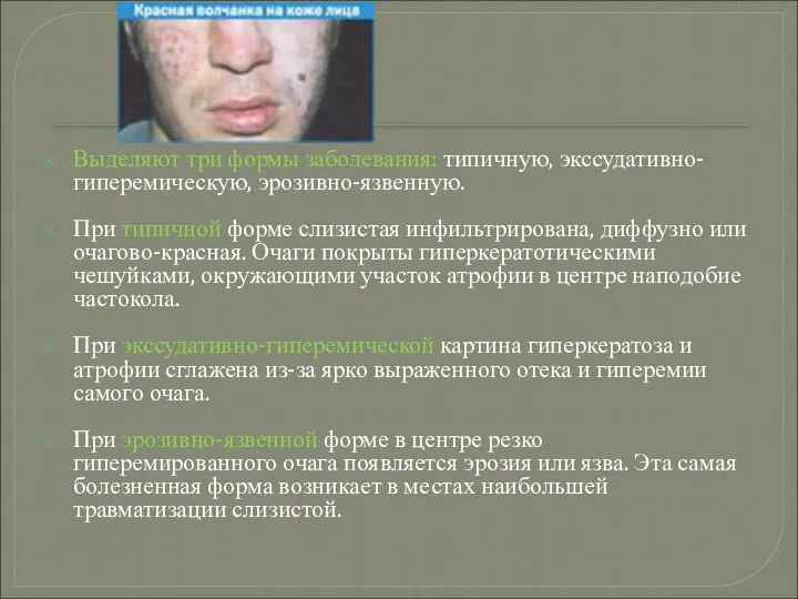 Выделяют три формы заболевания: типичную, экссудативно-гиперемическую, эрозивно-язвенную. При типичной форме слизистая