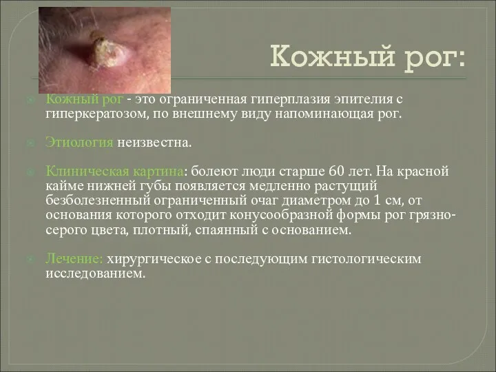 Кожный рог: Кожный рог - это ограниченная гиперплазия эпителия с гиперкератозом,