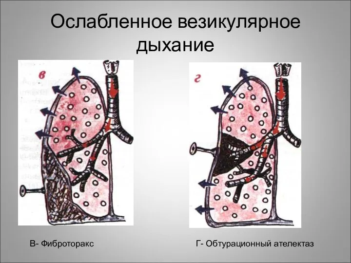 Ослабленное везикулярное дыхание В- Фиброторакс Г- Обтурационный ателектаз