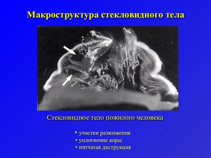 Макроструктура стекловидного тела Стекловидное тело пожилого человека участки разжижения уплотнение коры нитчатая деструкция