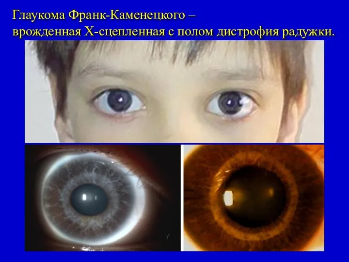 Глаукома Франк-Каменецкого – врожденная Х-сцепленная с полом дистрофия радужки.