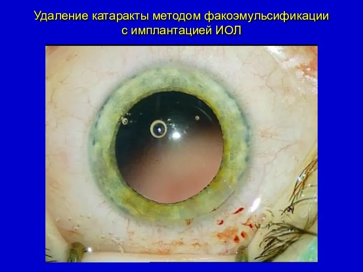 Удаление катаракты методом факоэмульсификации с имплантацией ИОЛ