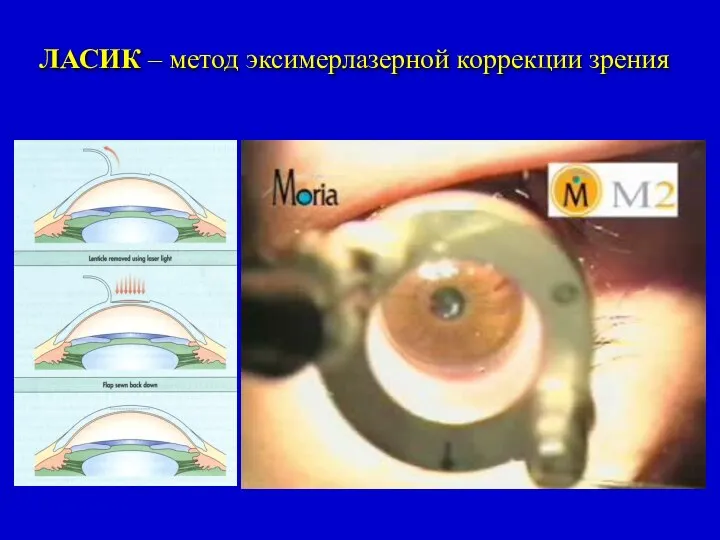 ЛАСИК – метод эксимерлазерной коррекции зрения