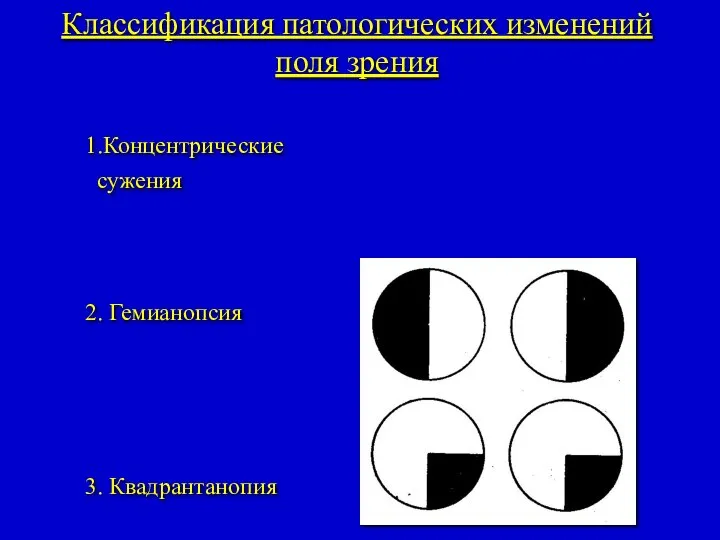 Классификация патологических изменений поля зрения 1.Концентрические сужения 2. Гемианопсия 3. Квадрантанопия