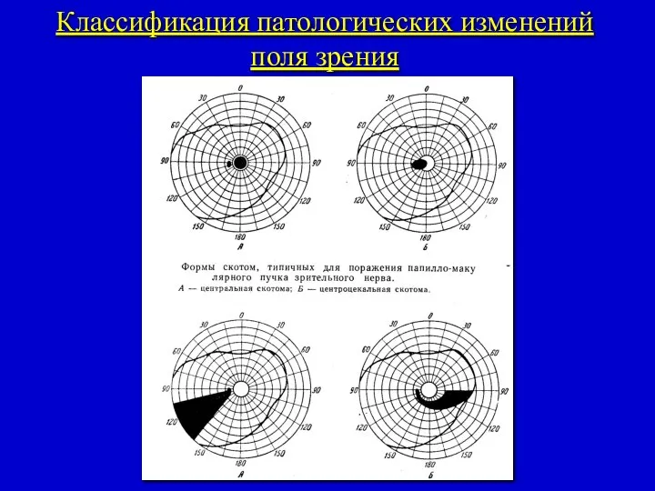 Классификация патологических изменений поля зрения