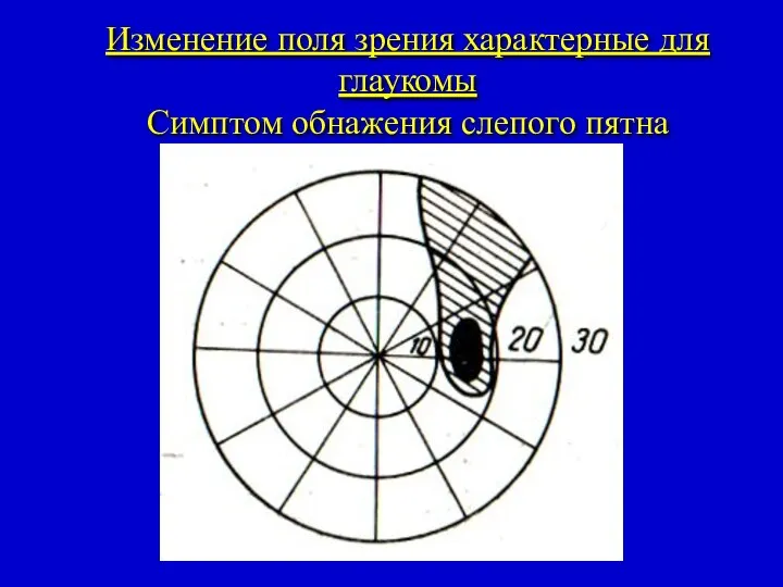 Изменение поля зрения характерные для глаукомы Симптом обнажения слепого пятна