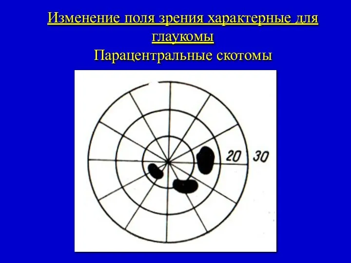 Изменение поля зрения характерные для глаукомы Парацентральные скотомы