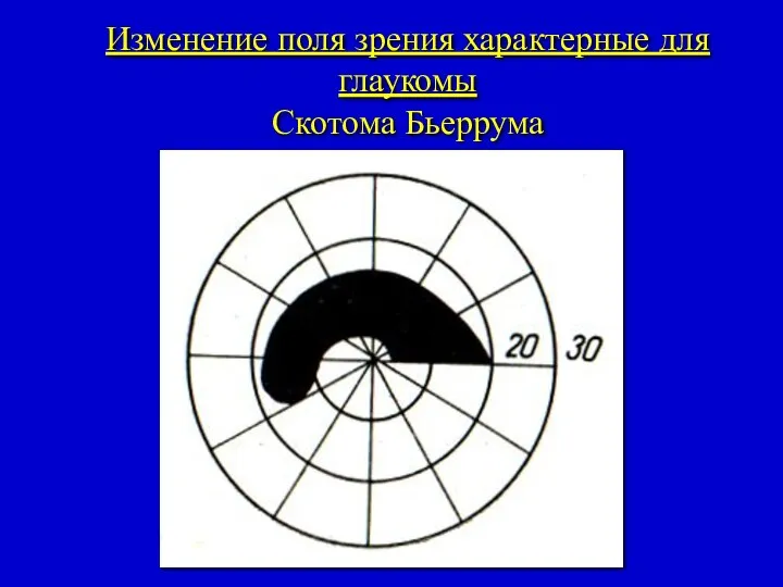 Изменение поля зрения характерные для глаукомы Скотома Бьеррума