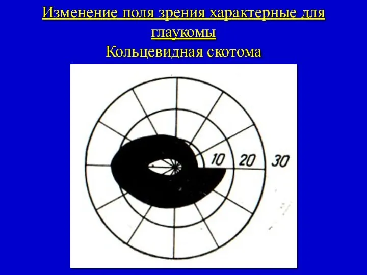 Изменение поля зрения характерные для глаукомы Кольцевидная скотома