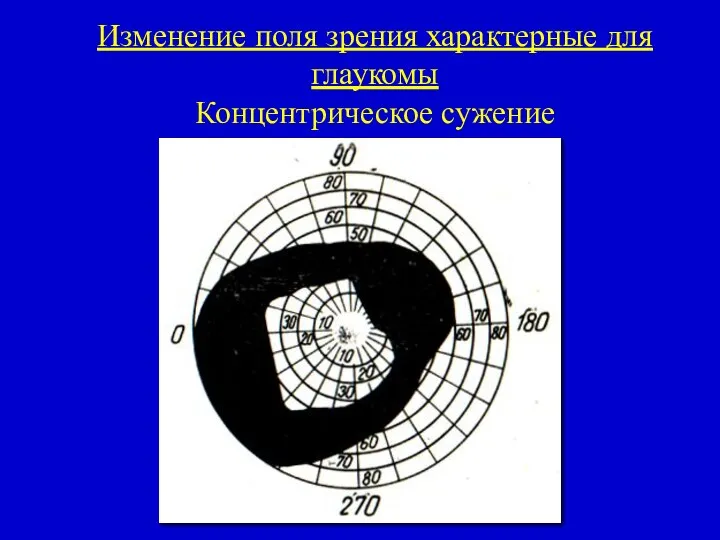 Изменение поля зрения характерные для глаукомы Концентрическое сужение