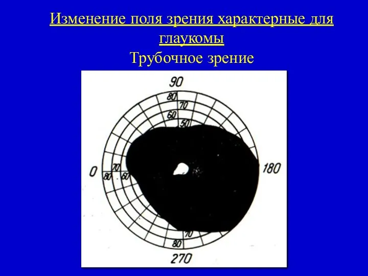 Изменение поля зрения характерные для глаукомы Трубочное зрение