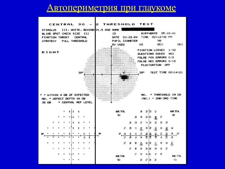 Автопериметрия при глаукоме