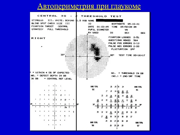 Автопериметрия при глаукоме