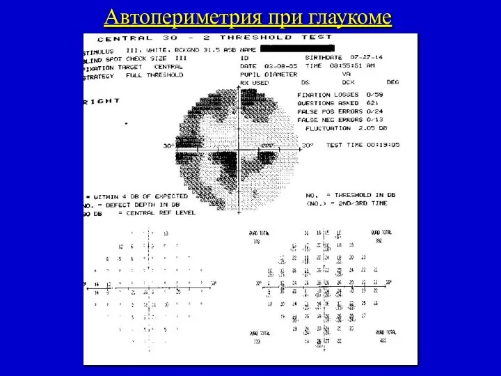 Автопериметрия при глаукоме