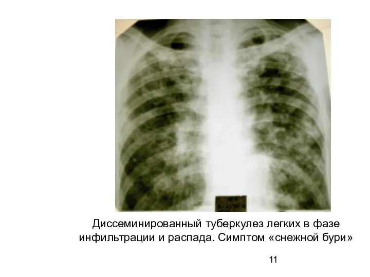 Диссеминированный туберкулез легких в фазе инфильтрации и распада. Симптом «снежной бури»