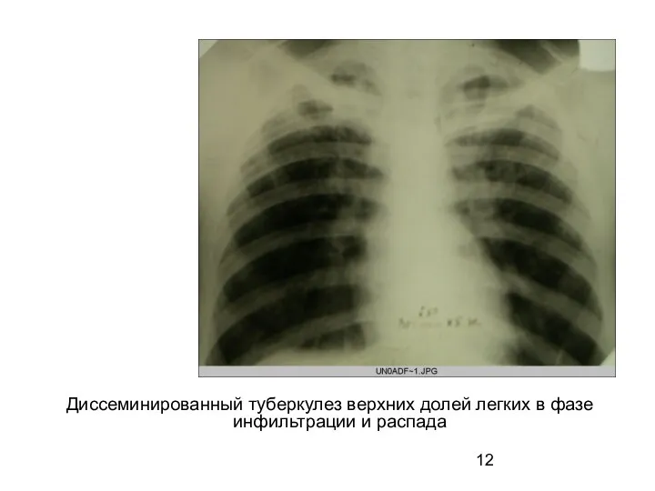 Диссеминированный туберкулез верхних долей легких в фазе инфильтрации и распада