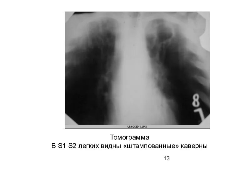 Томограмма В S1 S2 легких видны «штампованные» каверны