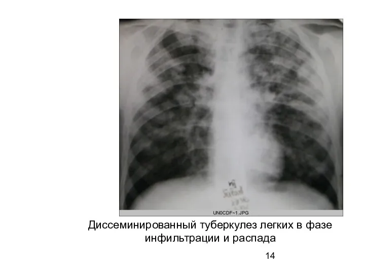 Диссеминированный туберкулез легких в фазе инфильтрации и распада