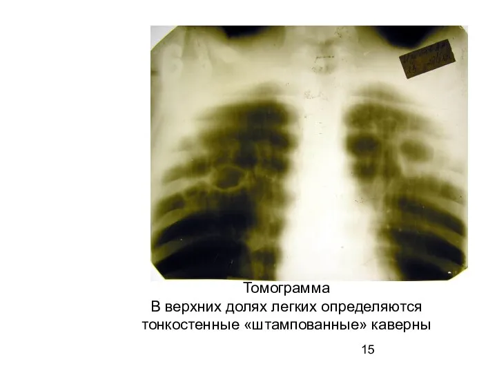 Томограмма В верхних долях легких определяются тонкостенные «штампованные» каверны