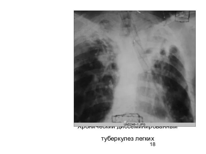 Хронический диссеминированный туберкулез легких