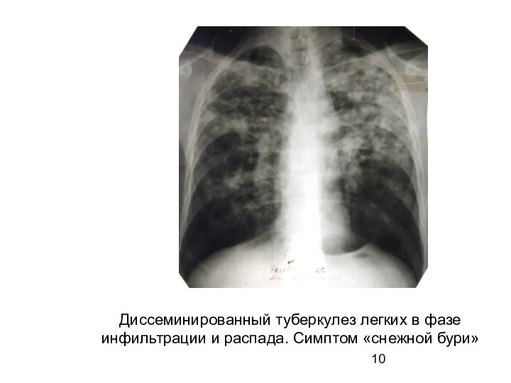 Диссеминированный туберкулез легких в фазе инфильтрации и распада. Симптом «снежной бури»