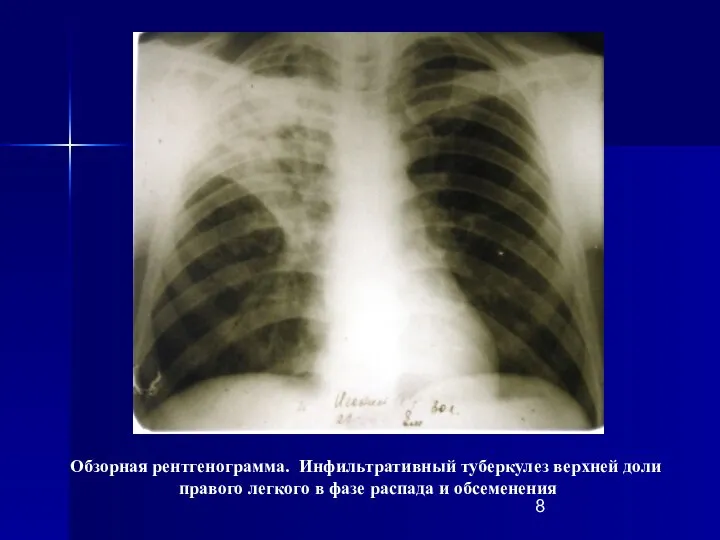 Обзорная рентгенограмма. Инфильтративный туберкулез верхней доли правого легкого в фазе распада и обсеменения