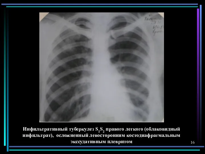 Инфильтративный туберкулез S1S2 правого легкого (облаковидный инфильтрат), осложненный левосторонним костодиафрагмальным экссудативным плевритом