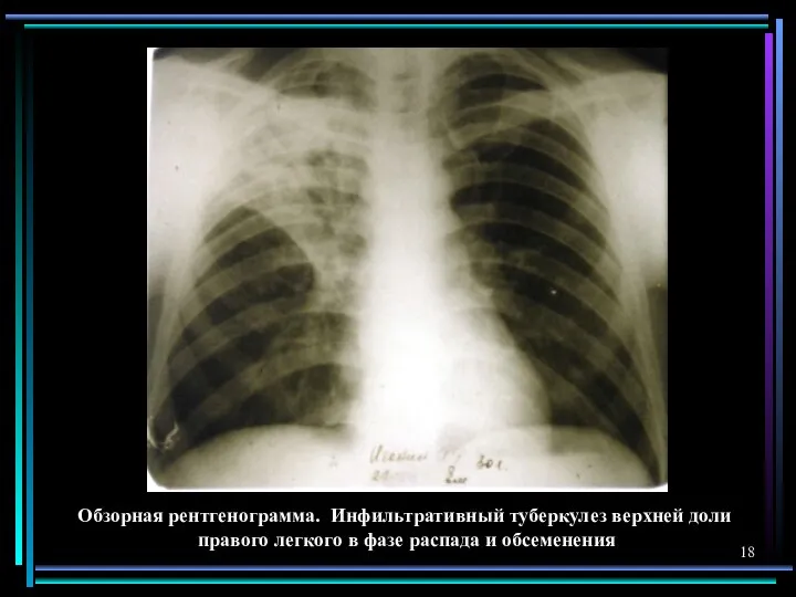 Обзорная рентгенограмма. Инфильтративный туберкулез верхней доли правого легкого в фазе распада и обсеменения