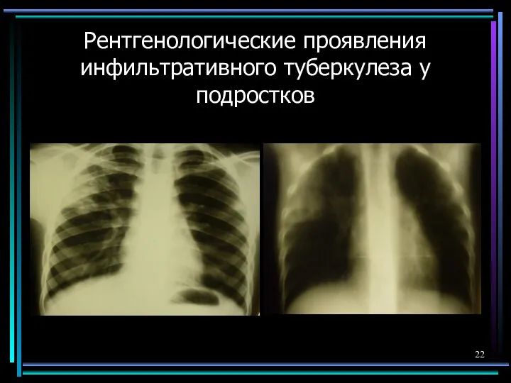 Рентгенологические проявления инфильтративного туберкулеза у подростков