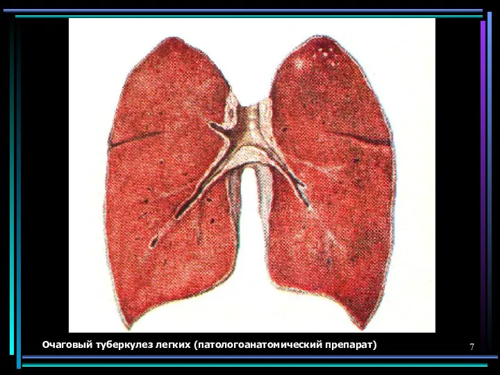 Очаговый туберкулез легких (патологоанатомический препарат)