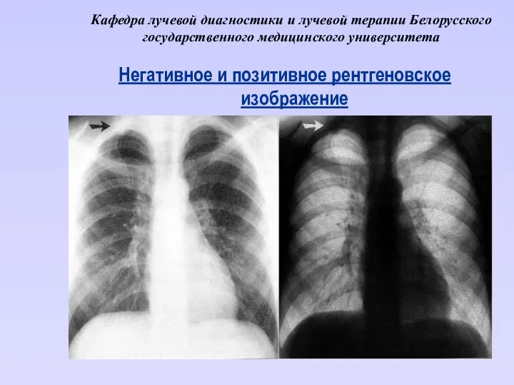 Кафедра лучевой диагностики и лучевой терапии Белорусского государственного медицинского университета Негативное и позитивное рентгеновское изображение