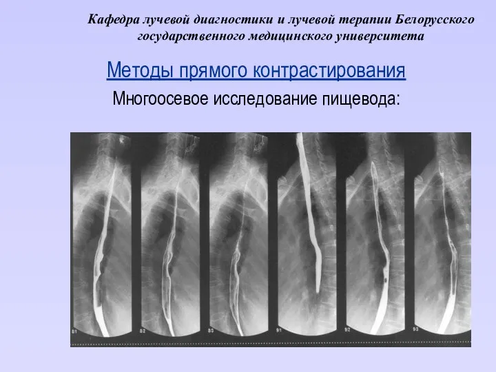 Кафедра лучевой диагностики и лучевой терапии Белорусского государственного медицинского университета Методы прямого контрастирования Многоосевое исследование пищевода: