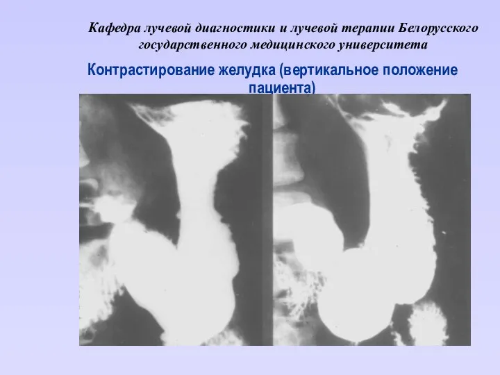 Кафедра лучевой диагностики и лучевой терапии Белорусского государственного медицинского университета Контрастирование желудка (вертикальное положение пациента)