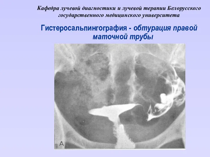 Кафедра лучевой диагностики и лучевой терапии Белорусского государственного медицинского университета Гистеросальпингография - обтурация правой маточной трубы