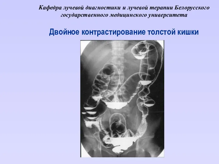 Кафедра лучевой диагностики и лучевой терапии Белорусского государственного медицинского университета Двойное контрастирование толстой кишки